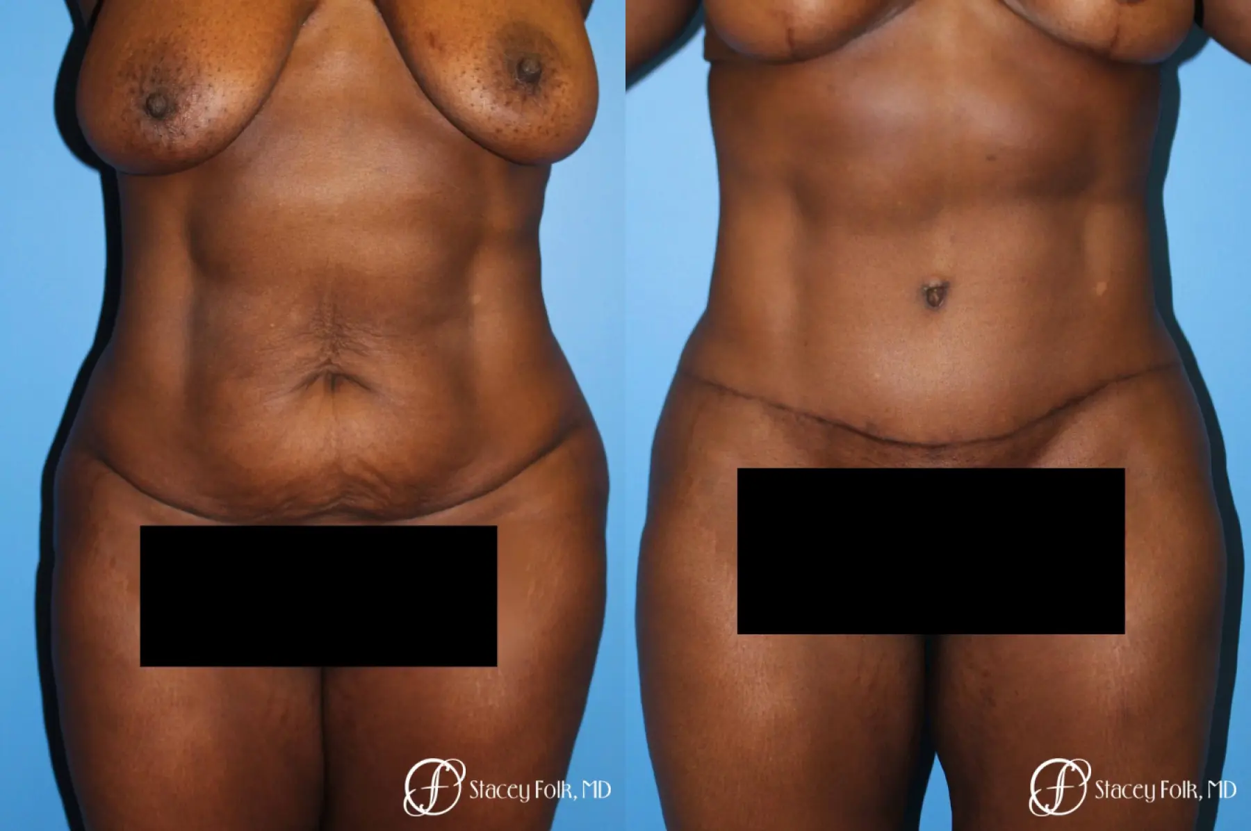 Denver Tummy Tuck - Abdominoplasty 7514 - Before and After