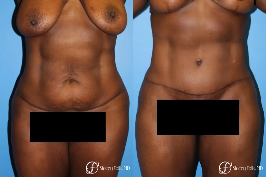 Denver Tummy Tuck - Abdominoplasty 7514 - Before and After 1