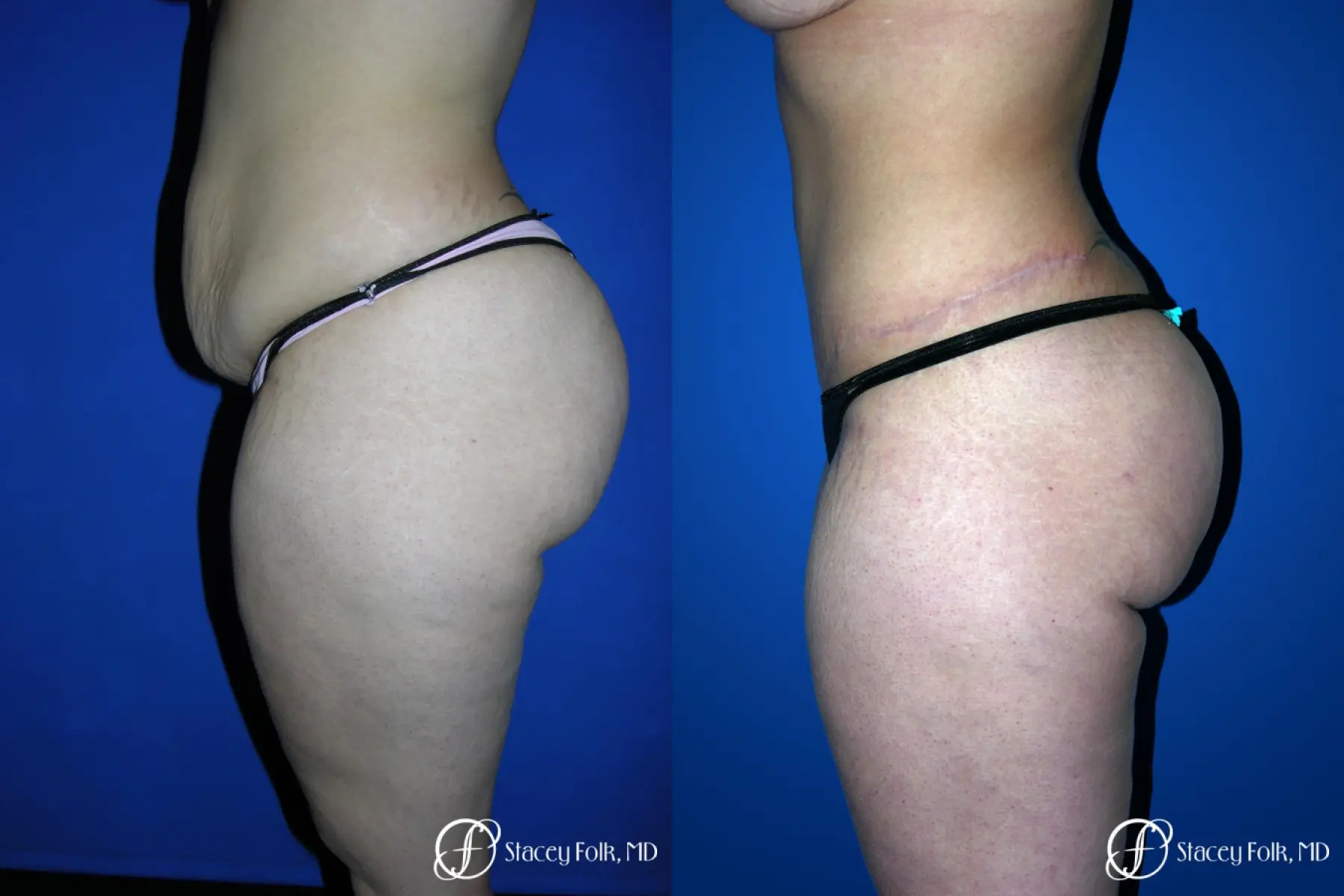 Denver Tummy Tuck 23 - Before and After 2