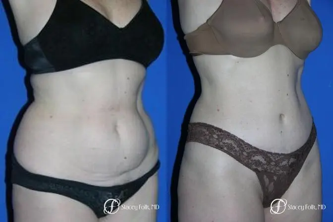 Denver Tummy Tuck 44 - Before and After 2