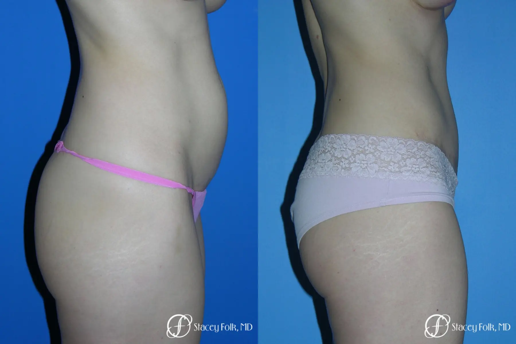 Denver Tummy Tuck - Abdominoplasty 10444 - Before and After 3