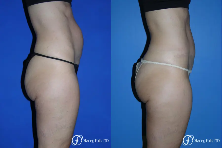 Denver Tummy Tuck Abdominoplasty 5485 - Before and After 2