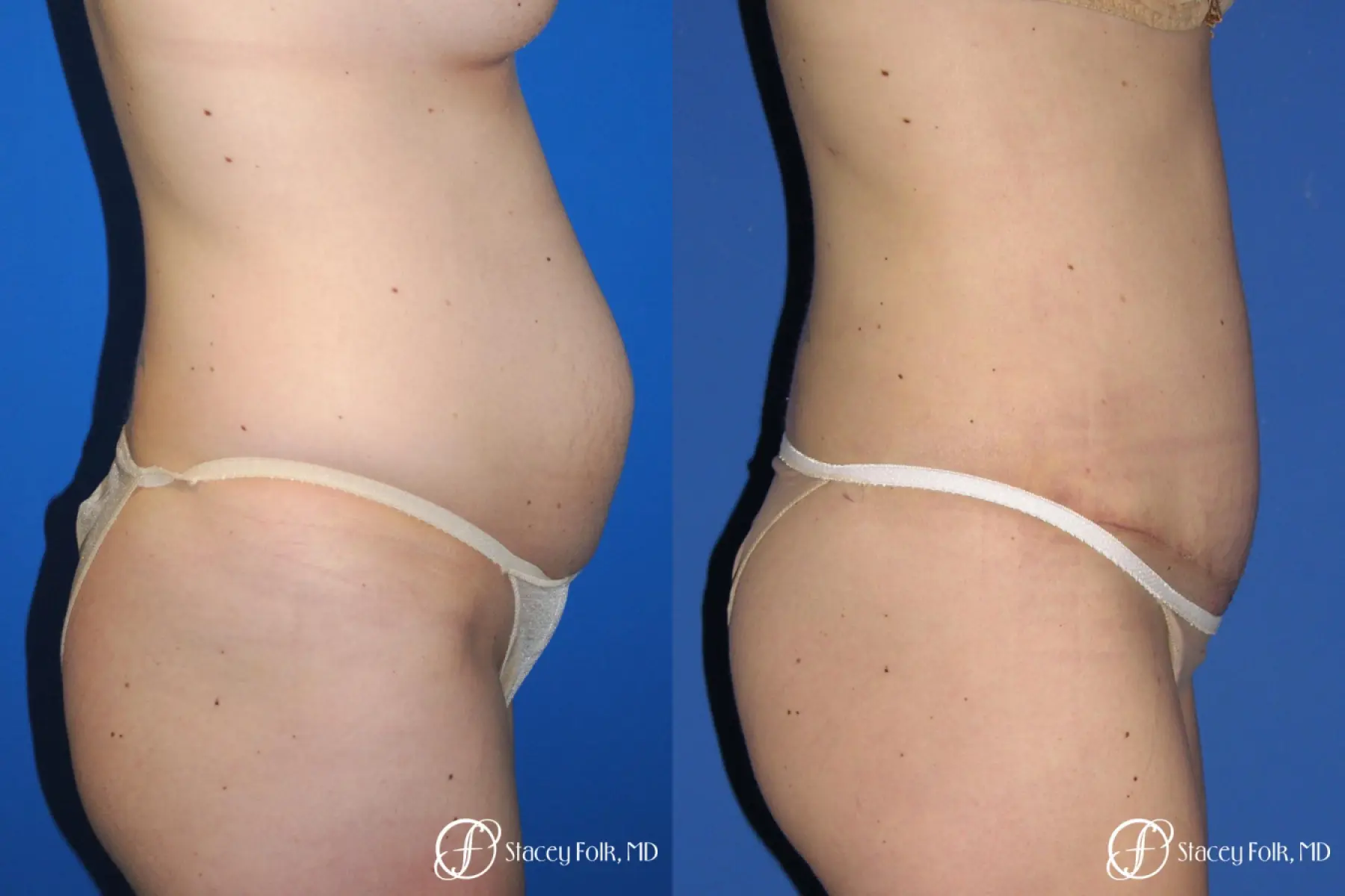 Denver Tummy Tuck - Abdominoplasty 10351 - Before and After 3