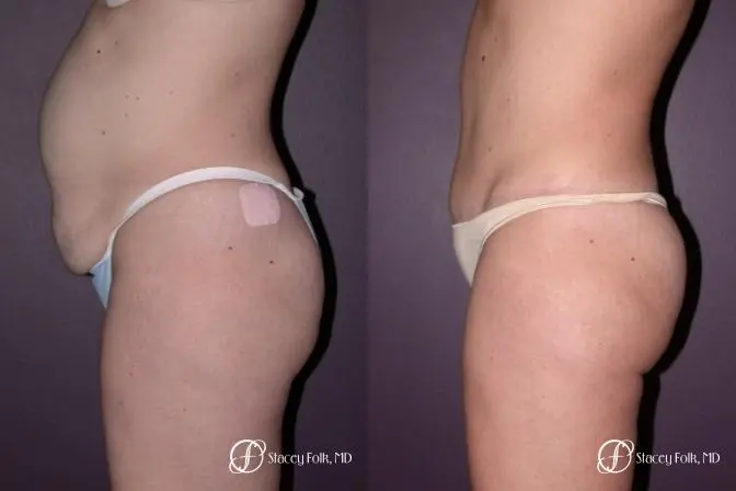 Denver Tummy Tuck 21 - Before and After 2