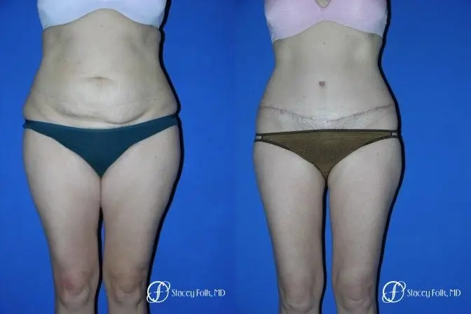Denver Tummy Tuck 34 - Before and After 1