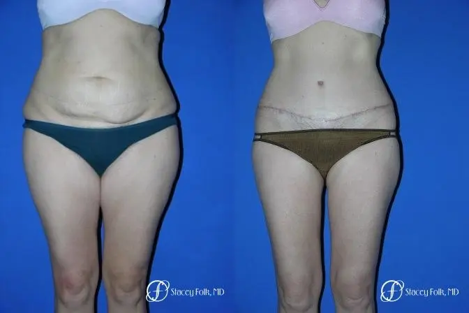 Denver Tummy Tuck 34 - Before and After