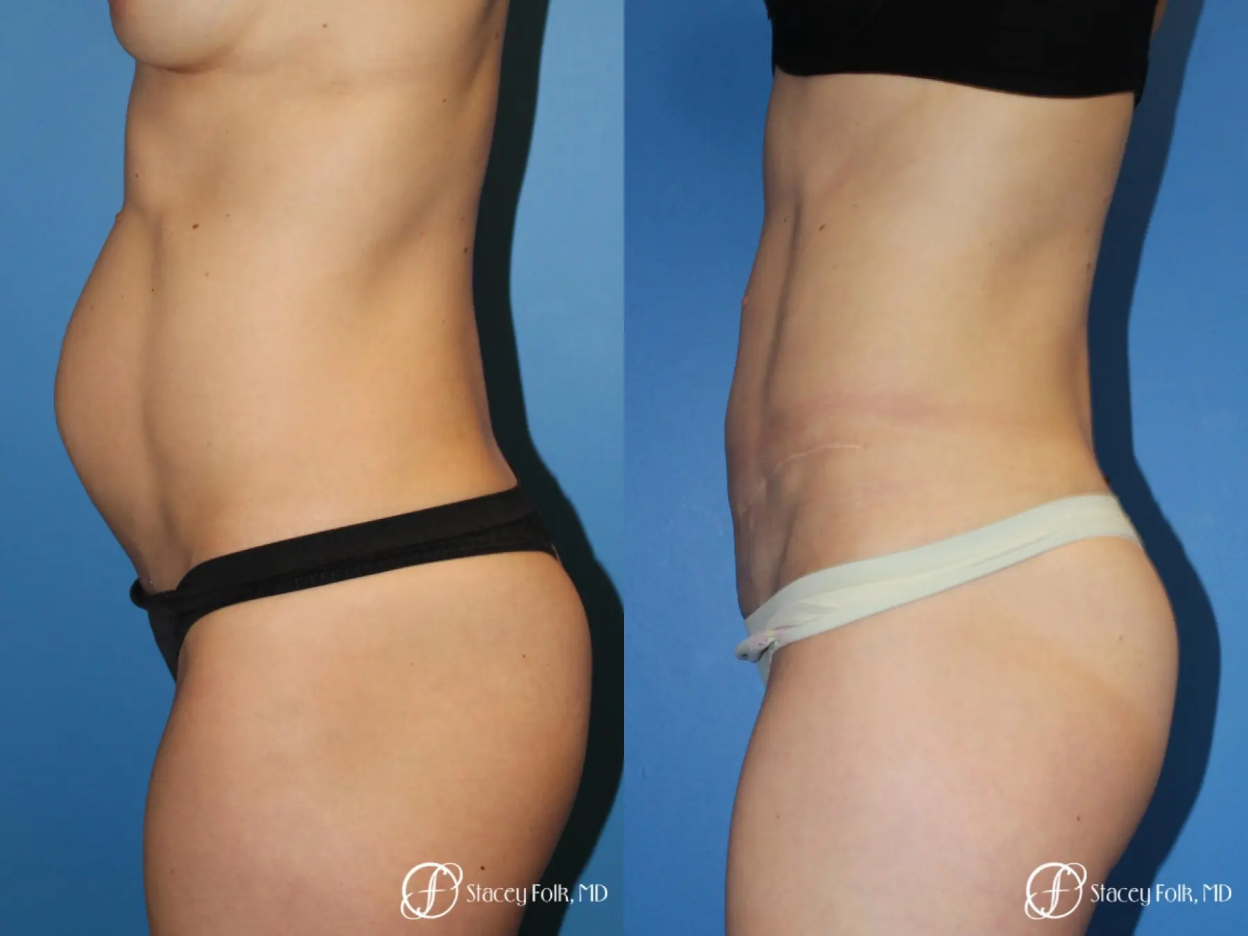 Denver Tummy Tuck (Abdominoplasty) 11239 - Before and After 3