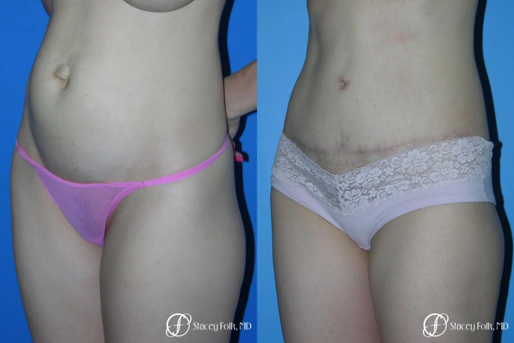 Denver Tummy Tuck - Abdominoplasty 10444 - Before and After 2