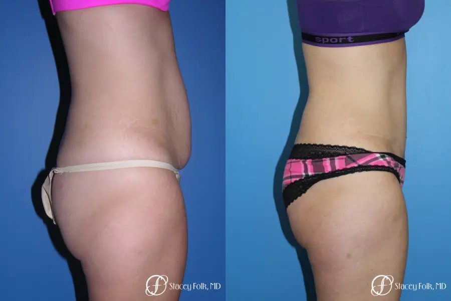 Denver Tummy Tuck (Abdominoplasty) 4782 - Before and After 2