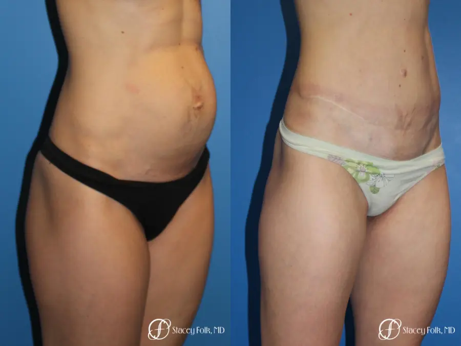 Denver Tummy Tuck (Abdominoplasty) 11239 - Before and After 4