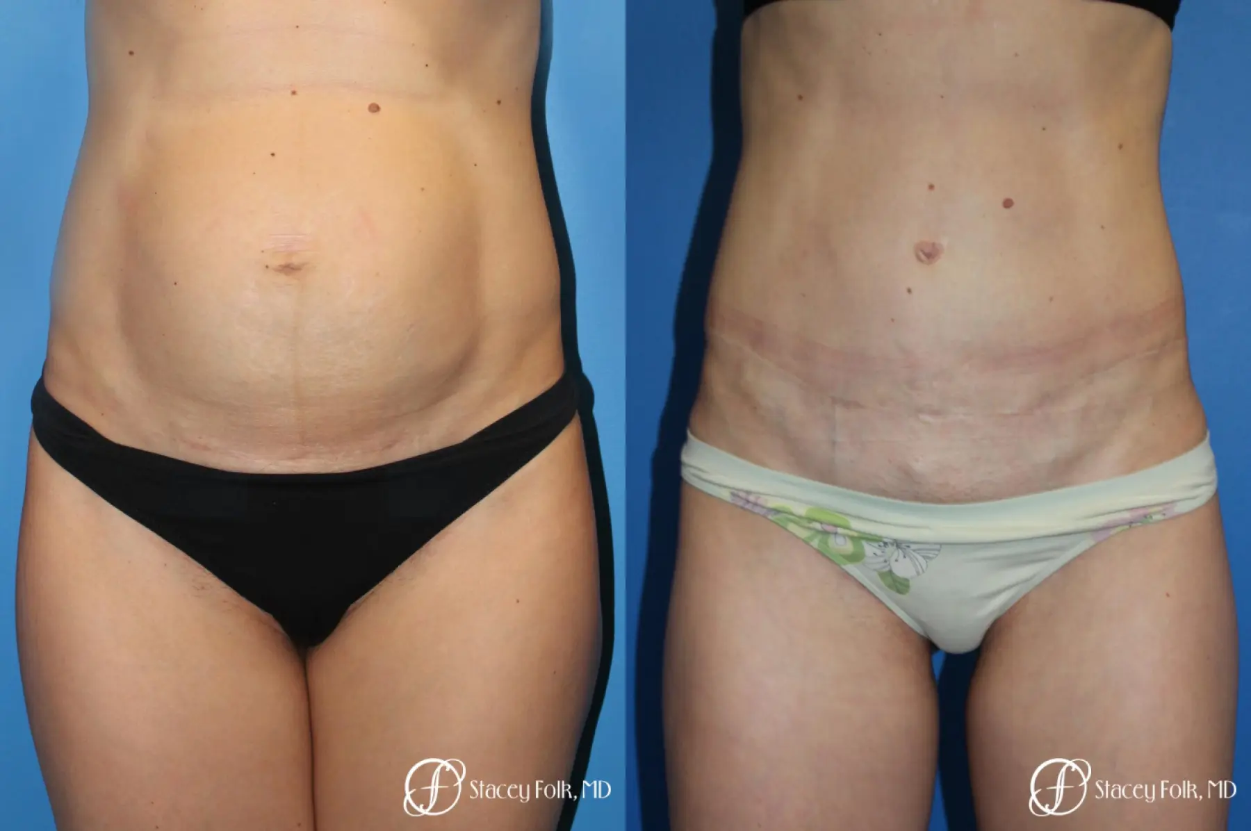 Denver Tummy Tuck (Abdominoplasty) 11239 - Before and After 1
