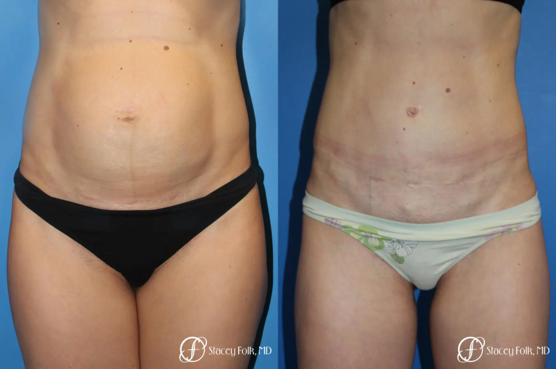 Tummy Tuck Liposuction in Denver