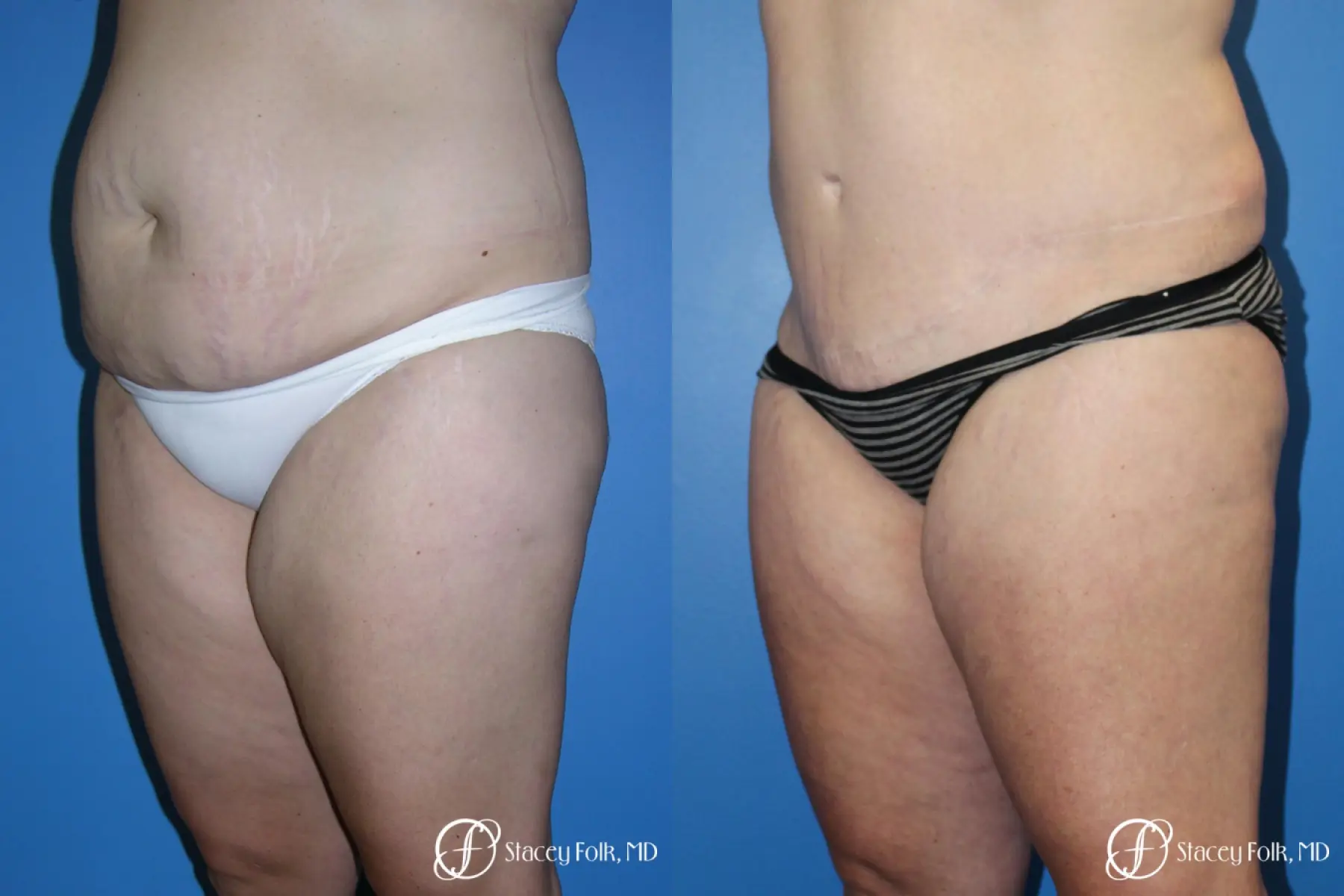 Denver Tummy Tuck (Abdominoplasty) and Liposuction 10381 - Before and After 2