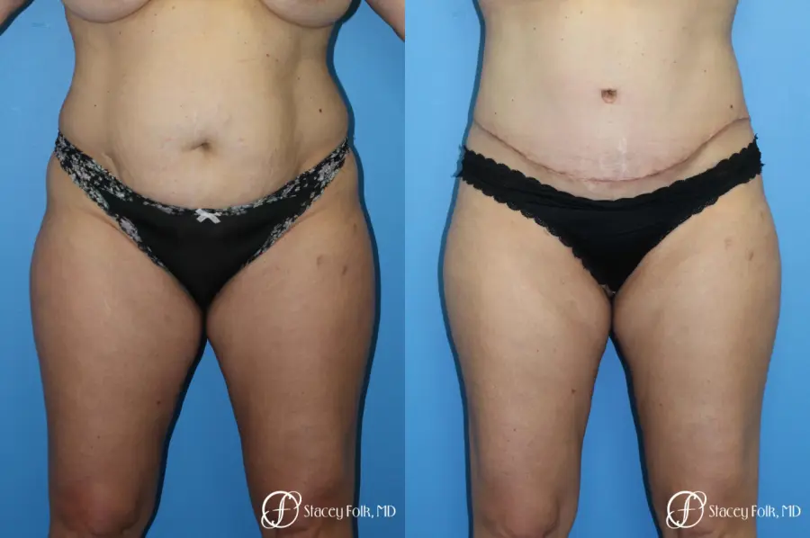 Tummy Tuck (Abdominoplasty) and Liposuction - Before and After 1
