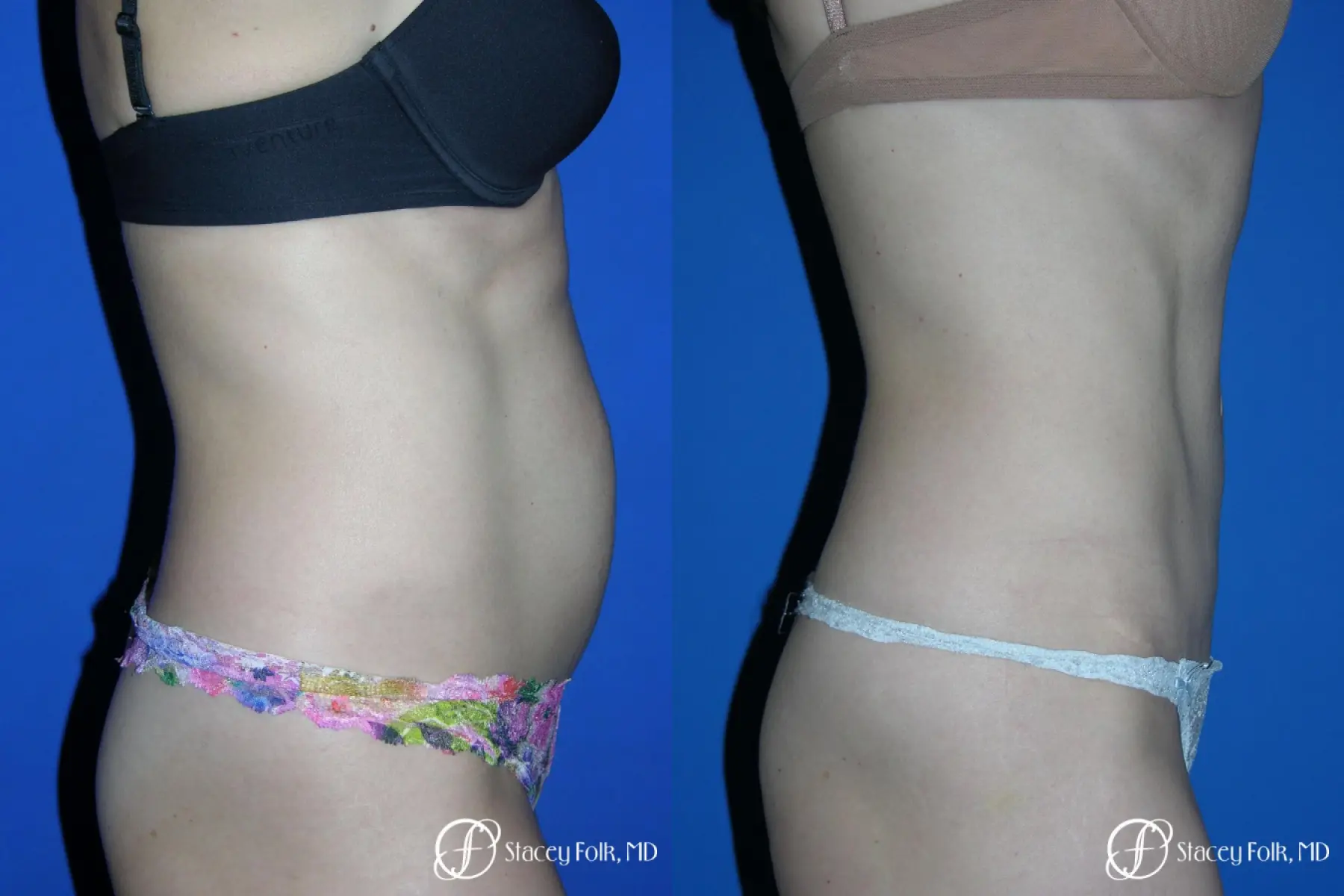 Denver Tummy Tuck Abdominoplasty 5456 - Before and After 3