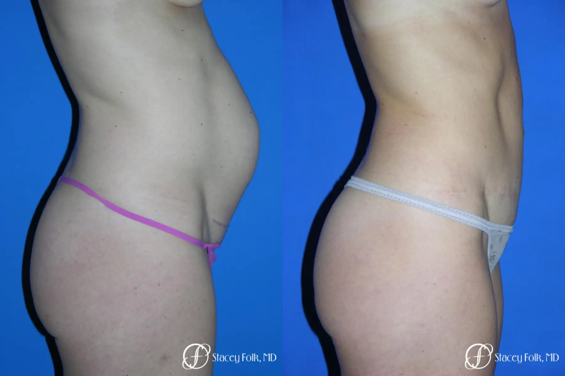 Denver Tummy Tuck 3528 - Before and After 2