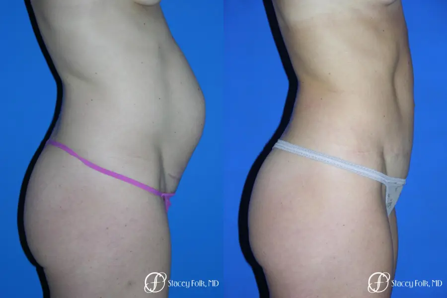 Denver Tummy Tuck 3528 - Before and After 2