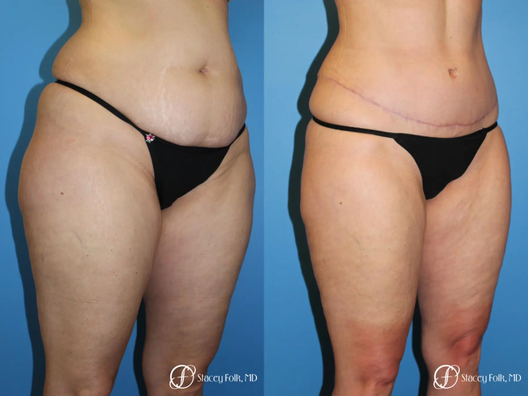 Tummy Tuck - Abdominoplasty - Before and After 2