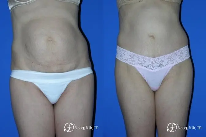 Denver Tummy Tuck 20 - Before and After