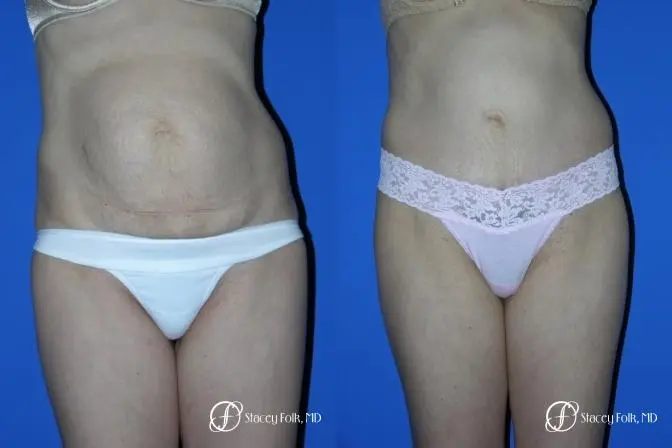 Denver Tummy Tuck 20 - Before and After 1