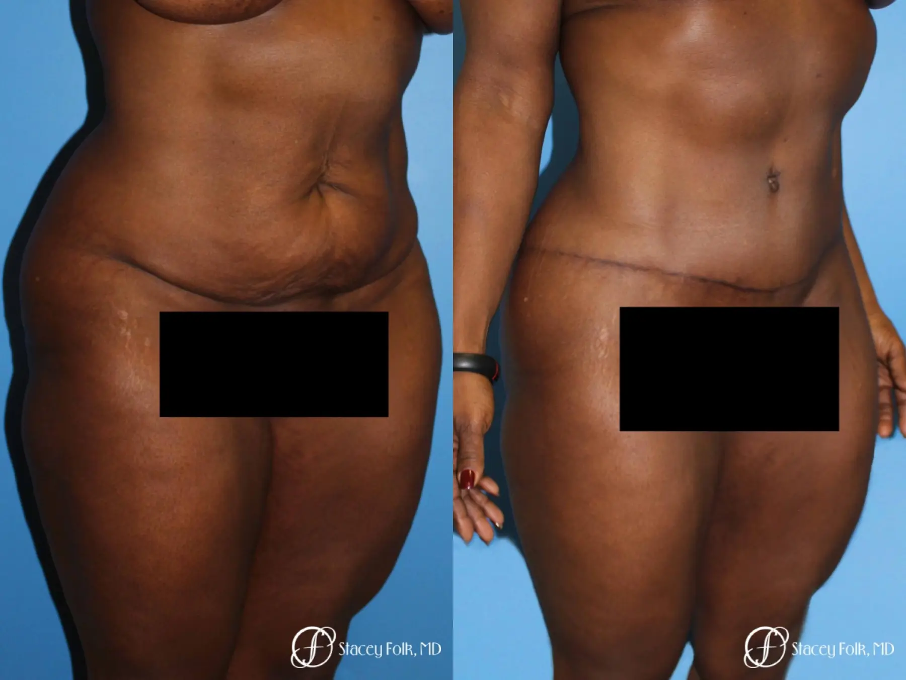 Denver Tummy Tuck - Abdominoplasty 7514 - Before and After 3