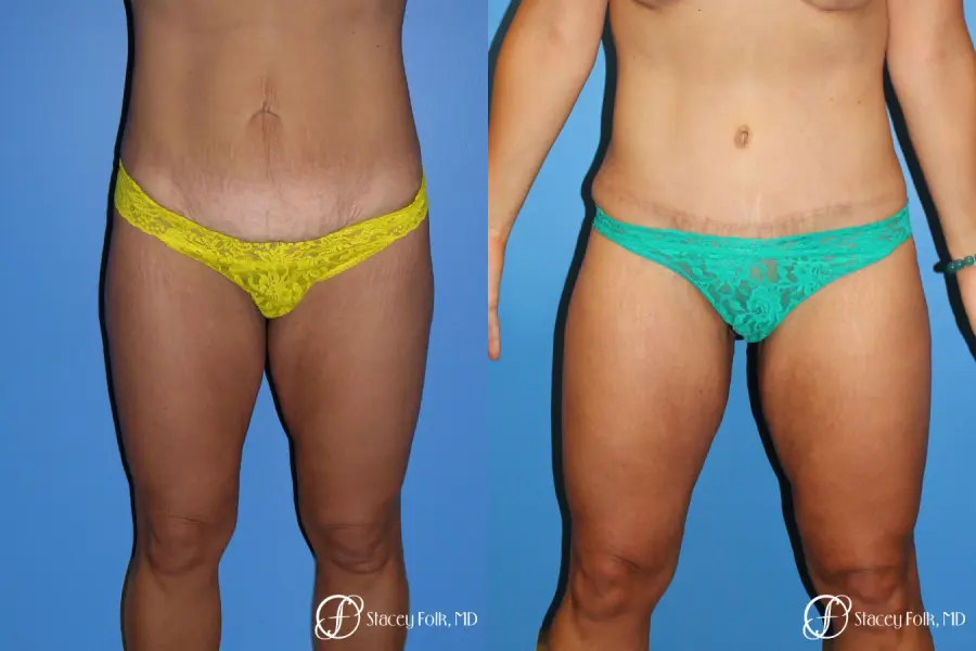 Denver Tummy Tuck Abdominoplasty 5368 - Before and After 1