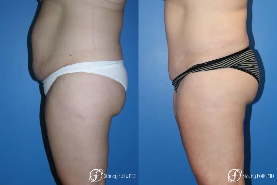 Denver Tummy Tuck (Abdominoplasty) and Liposuction 10381 - Before and After 3
