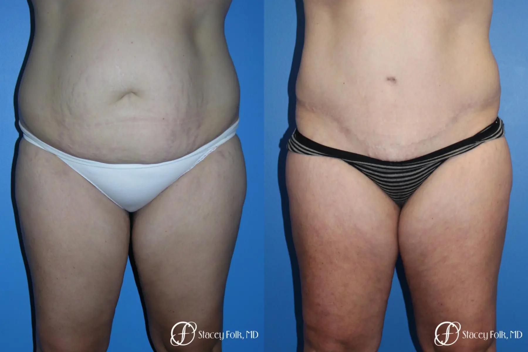 Denver Tummy Tuck (Abdominoplasty) and Liposuction 10381 - Before and After 1