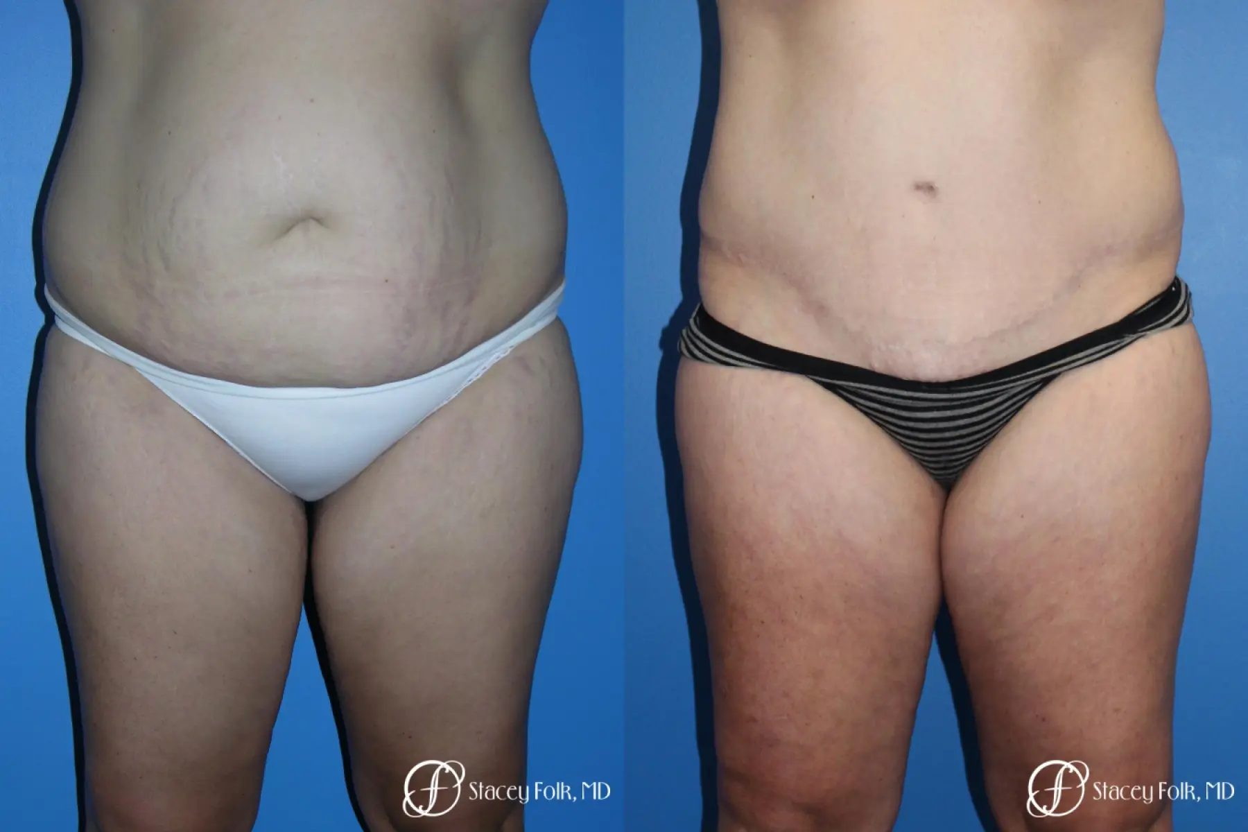 Denver Tummy Tuck (Abdominoplasty) and Liposuction 10381 - Before and After