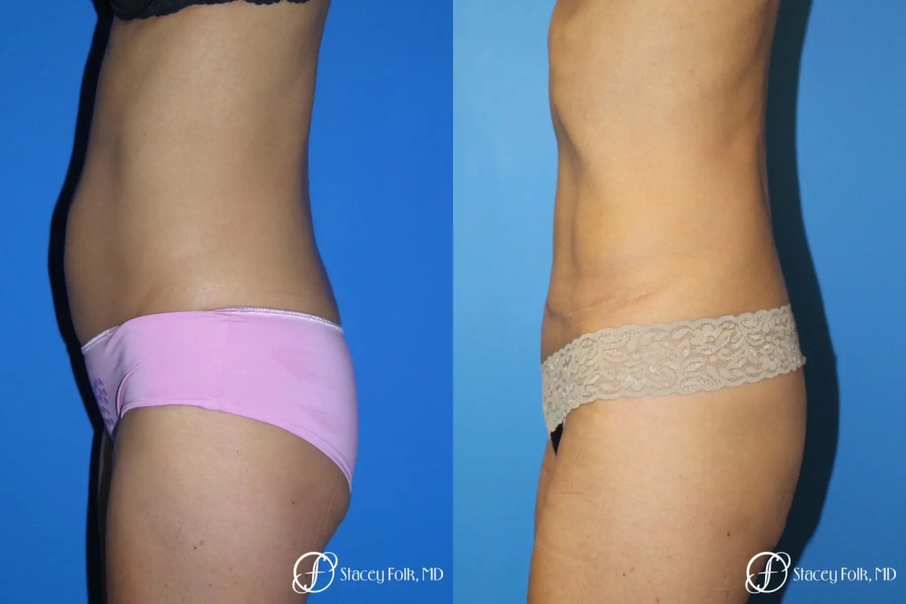 Denver Tummy Tuck Abdominoplasty 5609 - Before and After 3