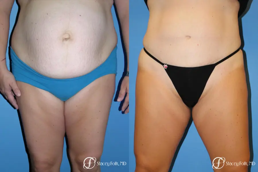 Denver Tummy Tuck - Abdominoplasty 7714 - Before and After 1