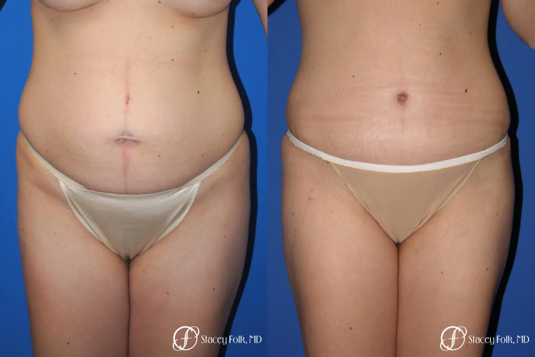 Denver Tummy Tuck - Abdominoplasty 10351 - Before and After 1