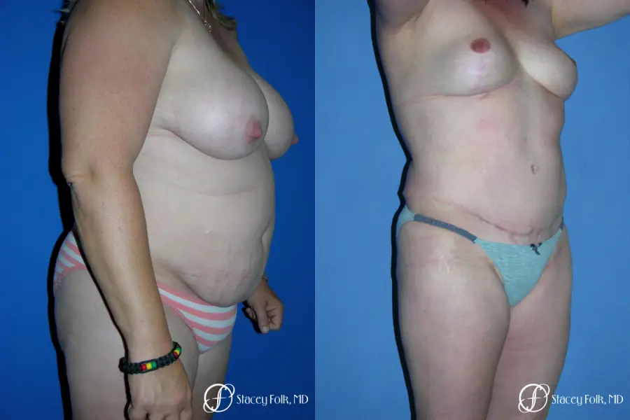 Denver Tummy Tuck 4783 - Before and After 2