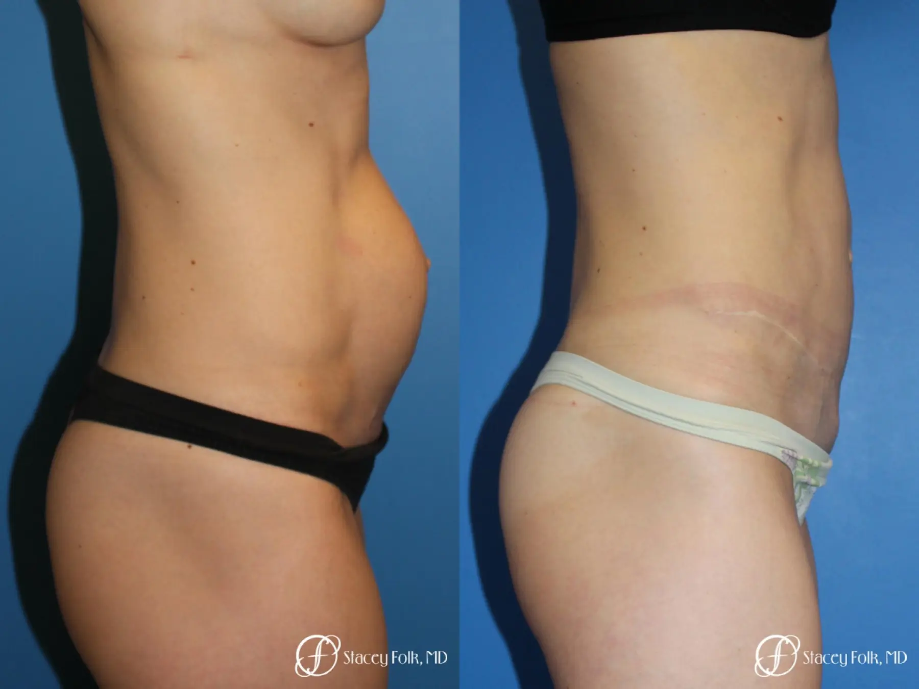 Denver Tummy Tuck (Abdominoplasty) 11239 - Before and After 5