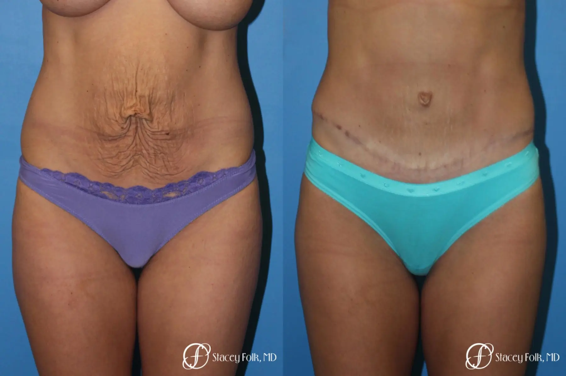 Denver Tummy Tuck - Abdominoplasty 8299 - Before and After