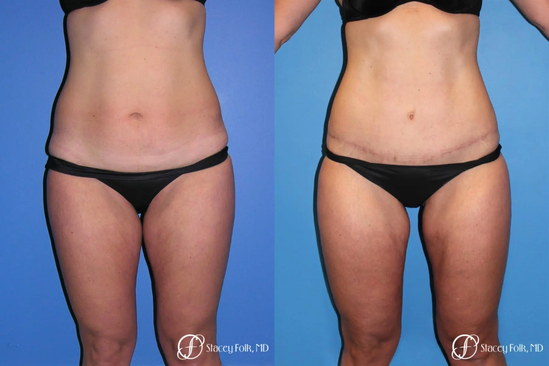 Denver Tummy Tuck Abdominoplasty and liposuction 4880 - Before and After 1
