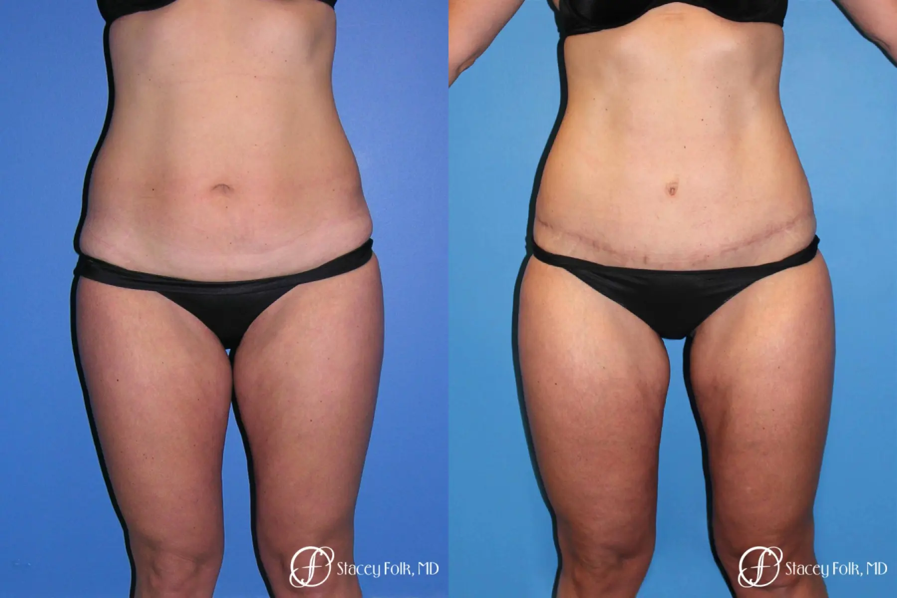 Denver Tummy Tuck Abdominoplasty and liposuction 4880 - Before and After