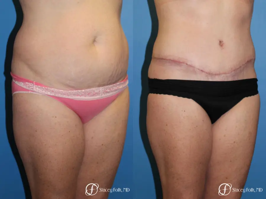 Denver Tummy Tuck 4817 - Before and After 2
