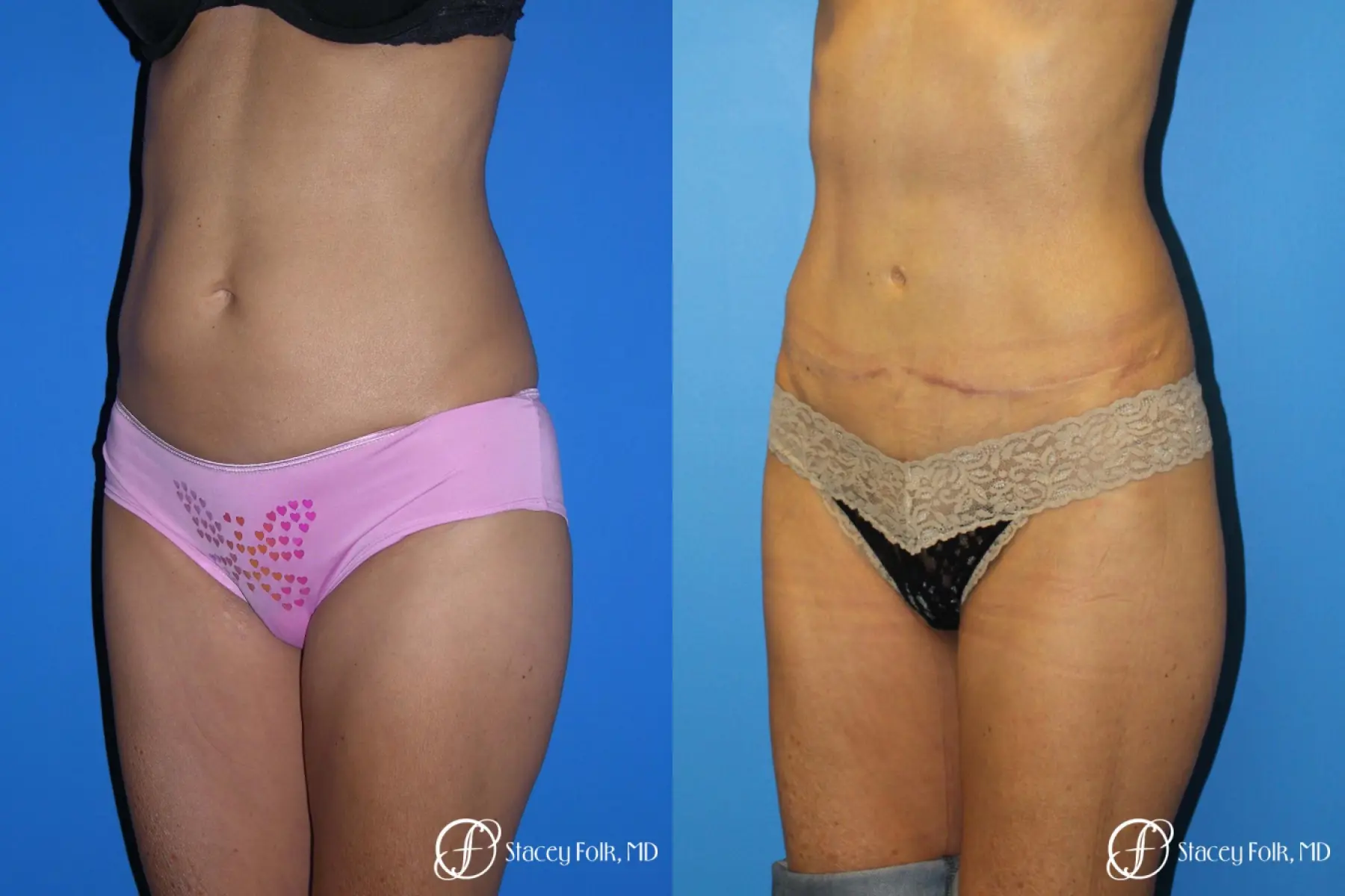 Denver Tummy Tuck Abdominoplasty 5609 - Before and After 2