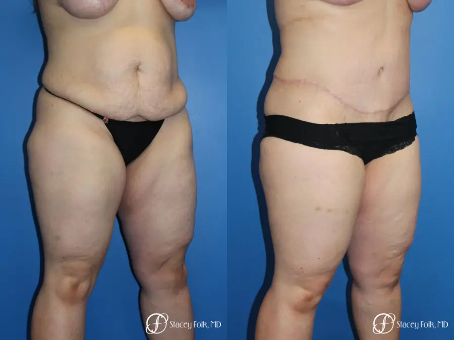 Tummy Tuck (Abdominoplasty) - Before and After 2