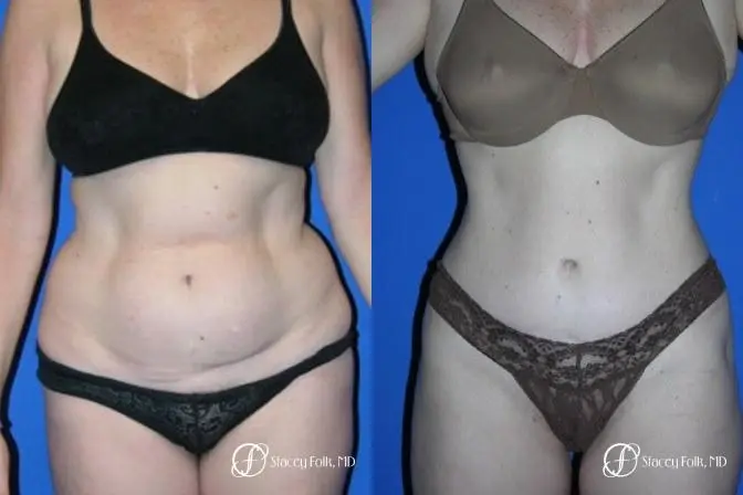 Denver Tummy Tuck 44 - Before and After