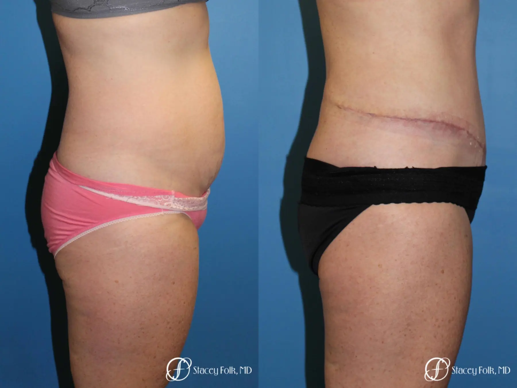 Denver Tummy Tuck 4817 - Before and After 3