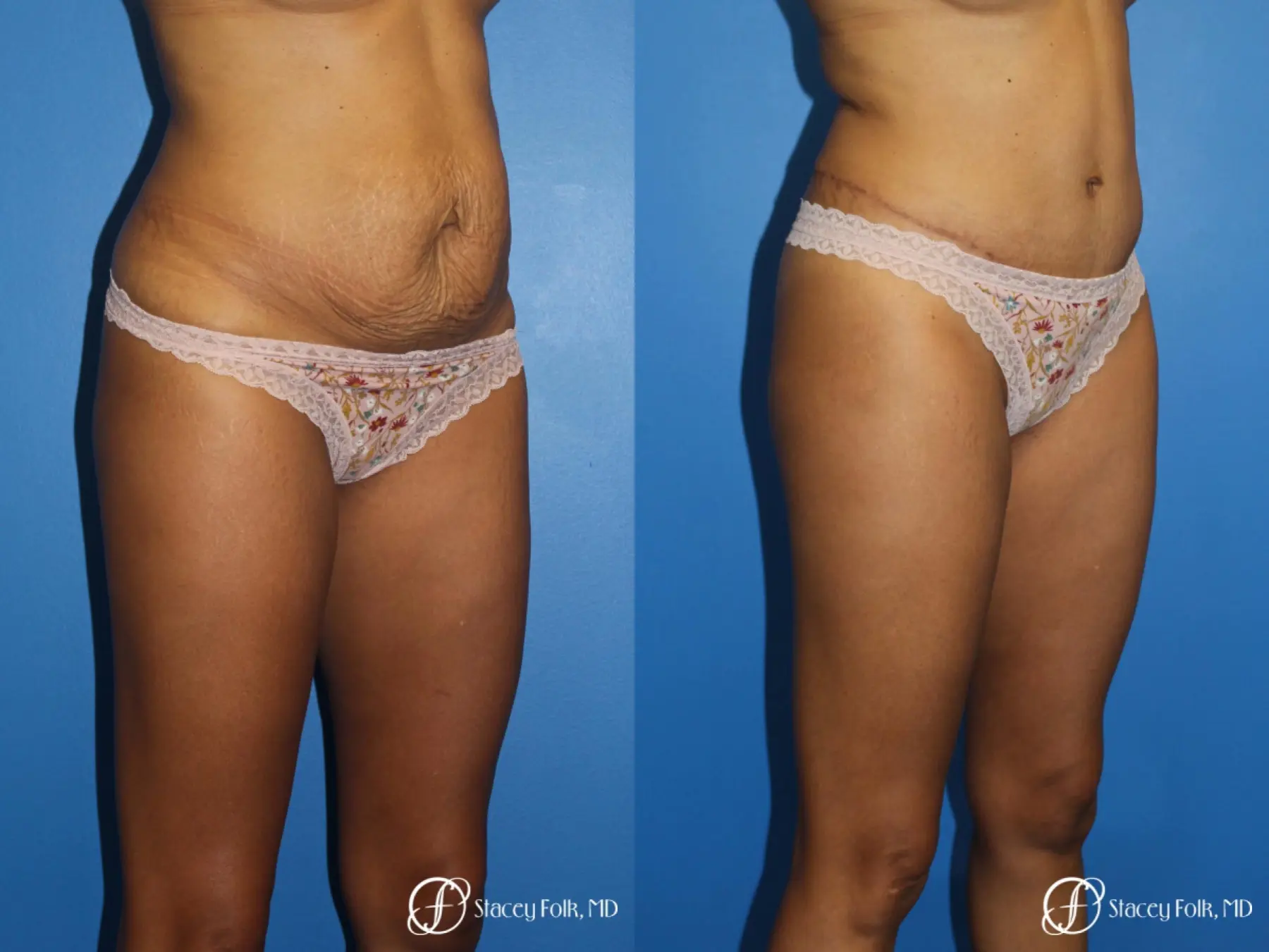 Tummy Tuck (Abdominoplasty) - Before and After 2