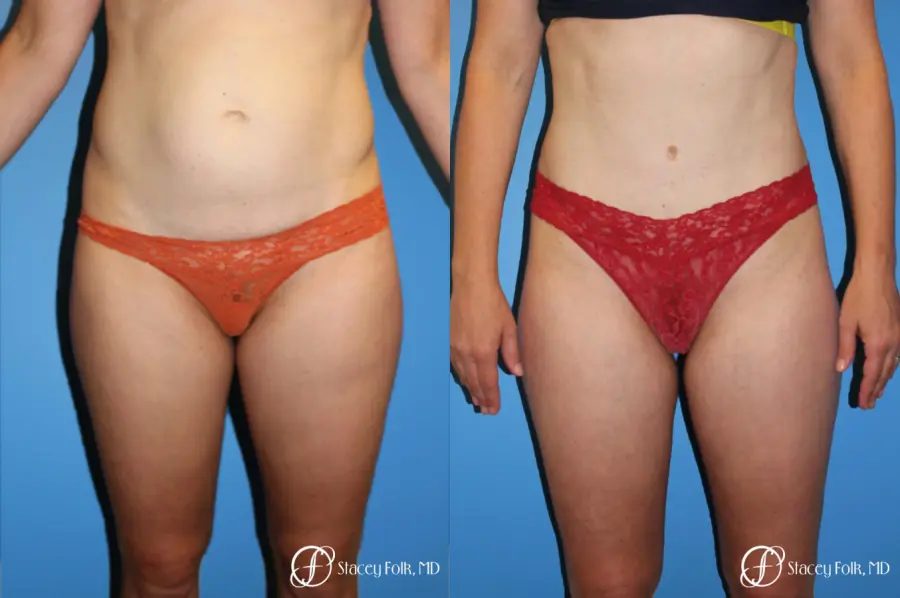 Denver Tummy Tuck - Abdominoplasty 8266 - Before and After 1