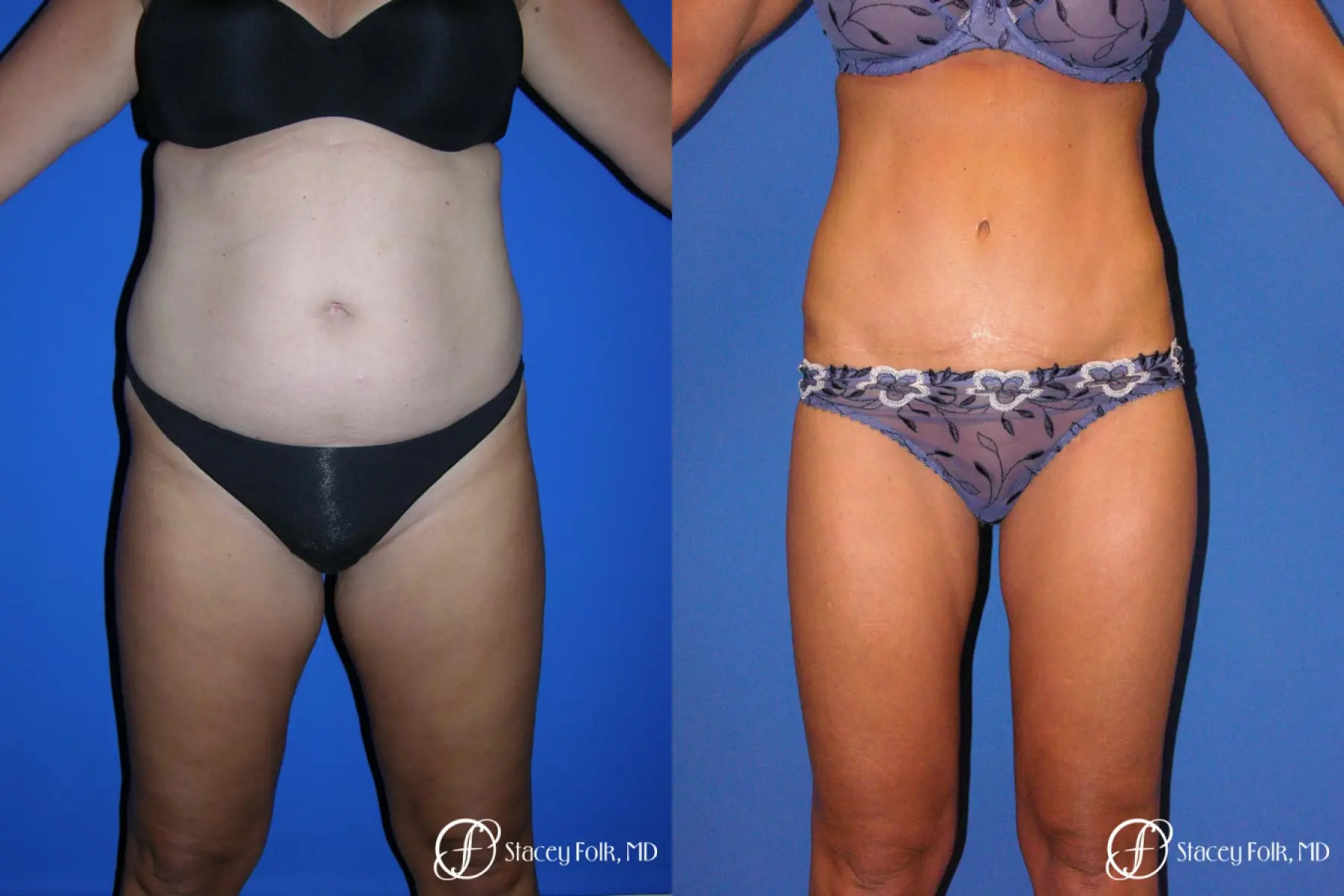 Denver Tummy Tuck - Abdominoplasty 53 - Before and After