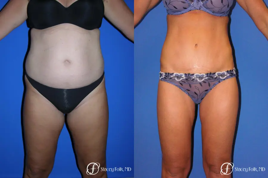 Denver Tummy Tuck - Abdominoplasty 53 - Before and After 1