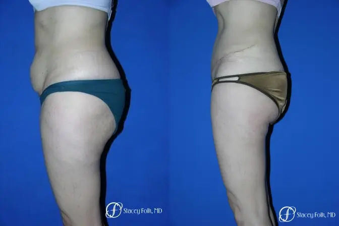 Denver Tummy Tuck 34 - Before and After 2