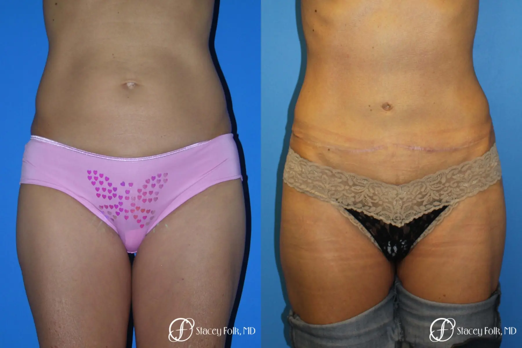 Denver Tummy Tuck Abdominoplasty 5609 - Before and After 1