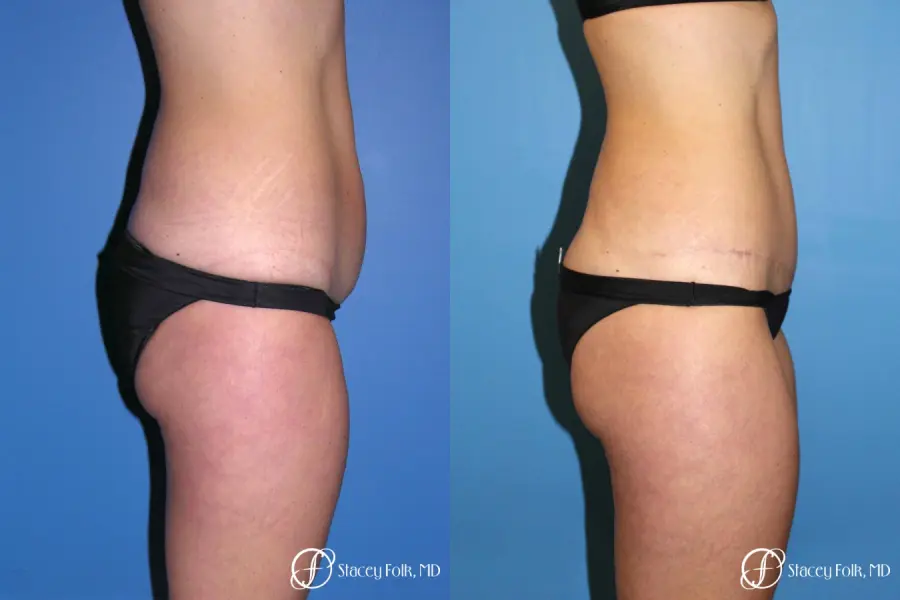 Denver Tummy Tuck Abdominoplasty and liposuction 4880 - Before and After 3