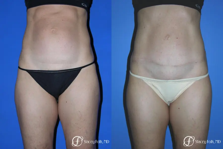 Denver Tummy Tuck Abdominoplasty 5485 - Before and After 1